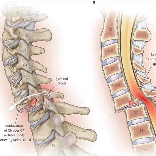 spinal cord compression